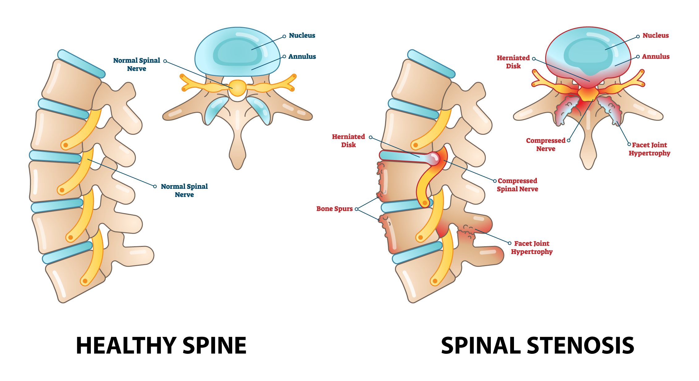 Stages of Lumbar Spinal Stenosis